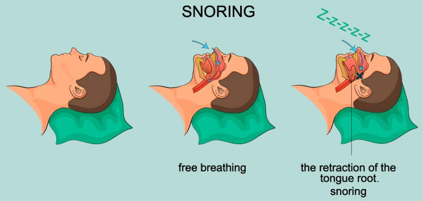 that you snore or have sleep apnea